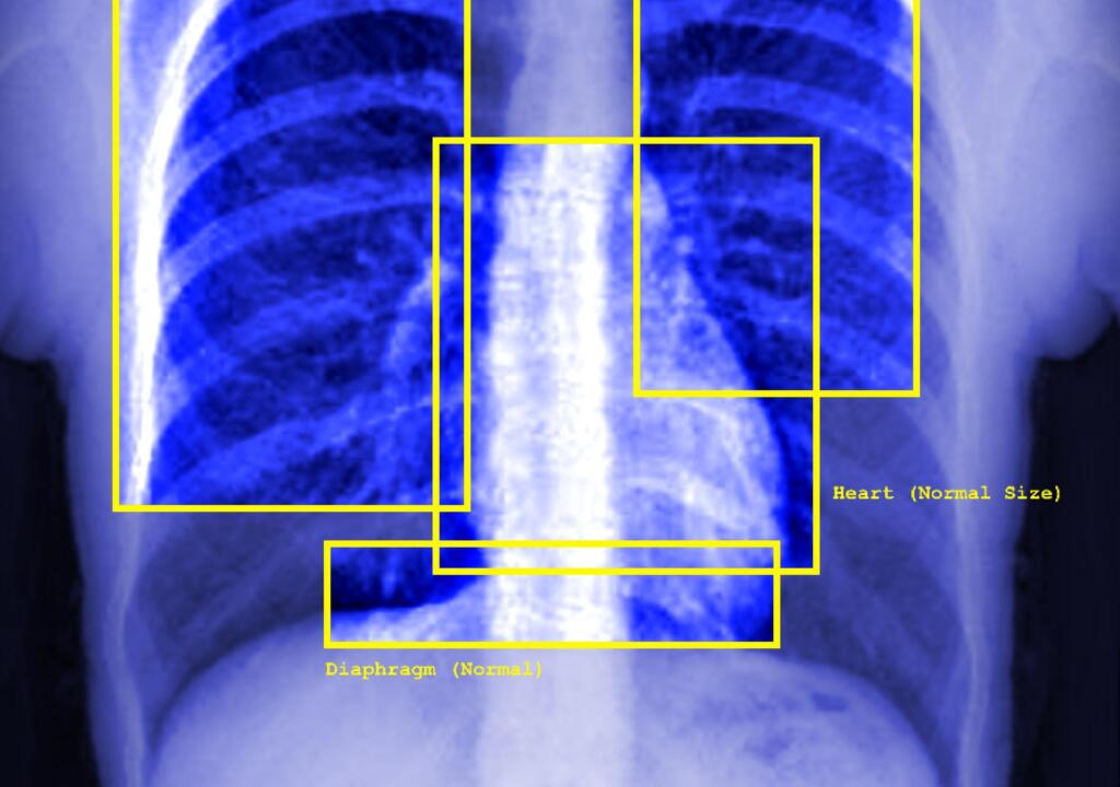 NL: Deze afbeelding toont een blauwe röntgenfoto van iemands borstkas - de ribben, de vage contouren van een hart en andere organen zijn zichtbaar. De afbeelding toont gele vierkanten rond de organen (linkerlong, luchtpijp, rechterlong, hart, middenrif) - elk met labels zoals: normaal, middenlijn, normale grootte. Rechtsonder staat in witte tekst 'geen afwijkingen gedetecteerd'.

EN: This image shows a blue xray image of a person's chest - it shows the ribs, the faint outline of a heart, and other organs. The image features yellow squares surrounding the organs (left lung, trachea, right lung, heart, diaphragm) - each of them feature labels such as: normal, midline, normal size. There is text in the right bottom corner in white which states 'no abnormalities detected'.